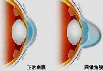 兰州眼科专家给你圆锥角膜诊疗常识