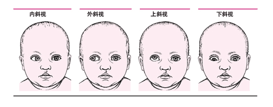 保守斜视有哪些方法?