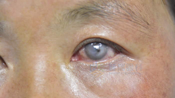 眼角膜移植需要哪些条件?