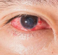 红眼病的人会有哪些症状